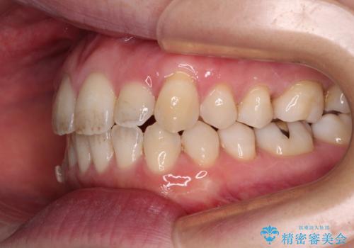 受け口傾向の歯並びをインビザラインで改善の治療中