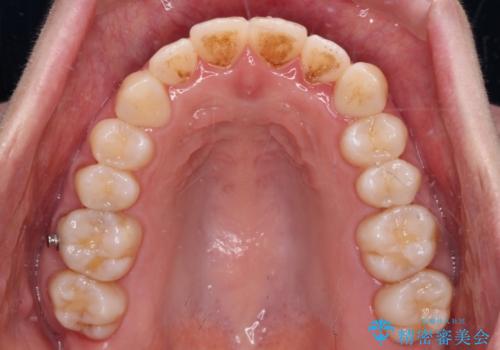 受け口傾向の歯並びをインビザラインで改善の治療中