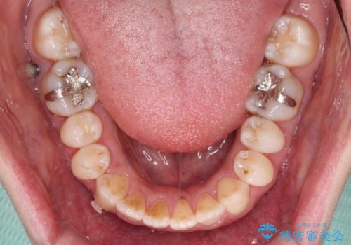 受け口傾向の歯並びをインビザラインで改善の治療中