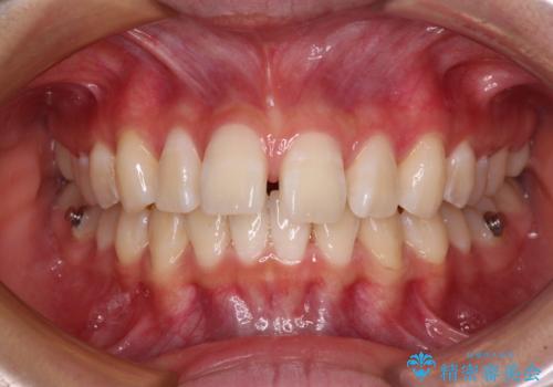 深い咬み合わせで前方に煽られた前歯 高校生のインビザライン矯正治療の治療中