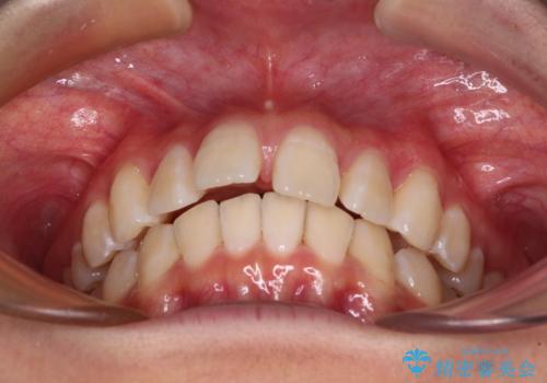 深い咬み合わせで前方に煽られた前歯 高校生のインビザライン矯正治療の治療中