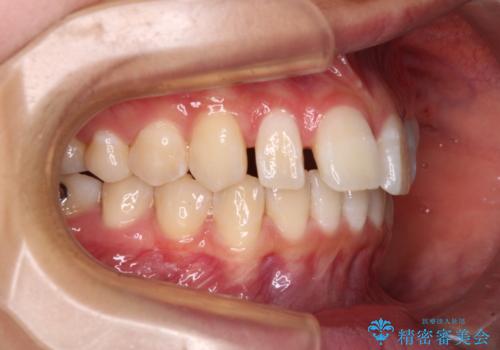 深い咬み合わせで前方に煽られた前歯 高校生のインビザライン矯正治療の治療中