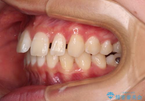 深い咬み合わせで前方に煽られた前歯 高校生のインビザライン矯正治療の治療中