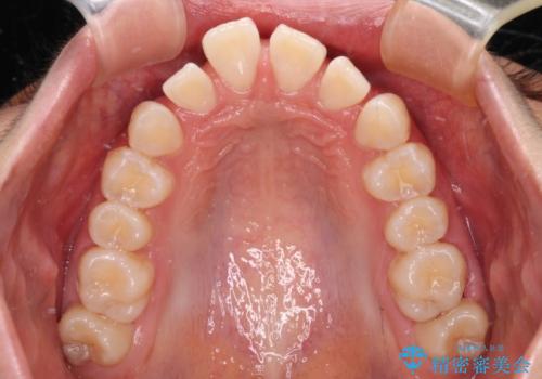 深い咬み合わせで前方に煽られた前歯 高校生のインビザライン矯正治療の治療中