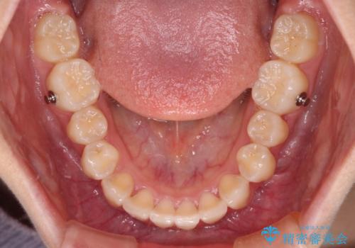 深い咬み合わせで前方に煽られた前歯 高校生のインビザライン矯正治療の治療中