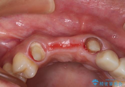 長く見える歯を治したい 歯肉移植による歯肉増大術の治療前