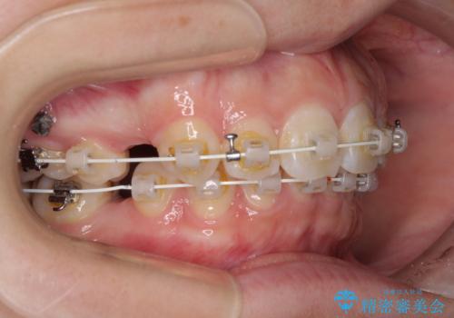 上顎前突による口元の突出感　強く深い咬合をワイヤー矯正で改善していくの治療中