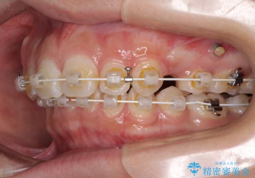 上顎前突による口元の突出感　強く深い咬合をワイヤー矯正で改善していくの治療中