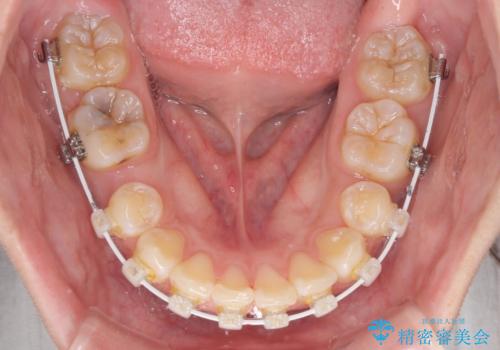 上顎前突による口元の突出感　強く深い咬合をワイヤー矯正で改善していくの治療中
