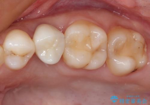 抜歯と言われた歯を残したい　部分矯正と外科処置を用いた補綴治療の症例 治療後