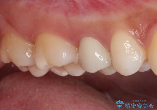 抜歯と言われた歯を残したい 部分矯正と外科処置を用いた補綴治療の治療後