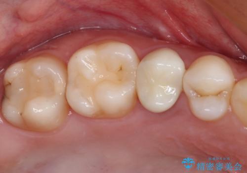 抜歯と言われた歯を残したい　部分矯正と外科処置を用いた補綴治療の治療後