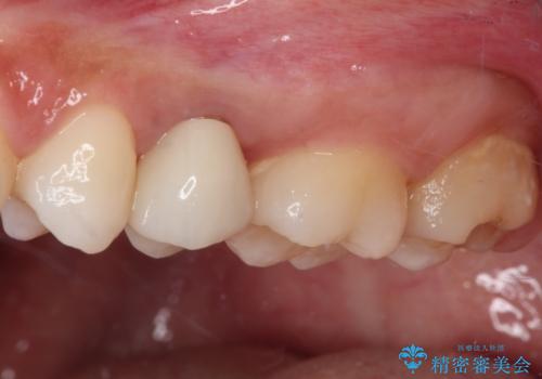 抜歯と言われた歯を残したい 部分矯正と外科処置を用いた補綴治療の治療後