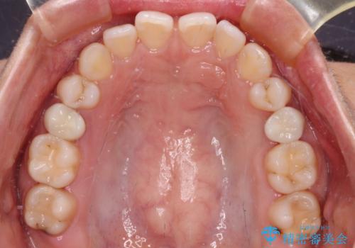 抜歯と言われた歯を残したい　部分矯正と外科処置を用いた補綴治療
