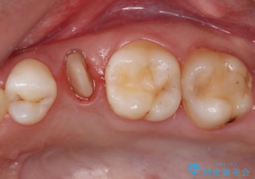 抜歯と言われた歯を残したい　部分矯正と外科処置を用いた補綴治療の治療中