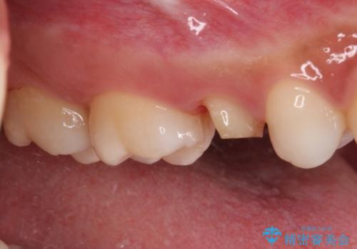 抜歯と言われた歯を残したい 部分矯正と外科処置を用いた補綴治療の治療中