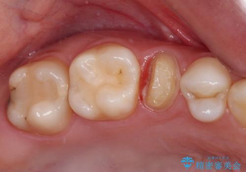 抜歯と言われた歯を残したい 部分矯正と外科処置を用いた補綴治療の治療中