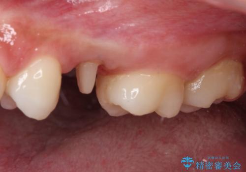 抜歯と言われた歯を残したい　部分矯正と外科処置を用いた補綴治療の治療中