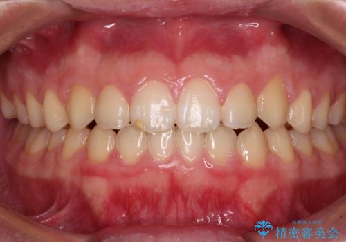 舌突出癖で隙間の空いてしまう歯列　舌トレーニングを行ったインビザライン矯正の症例 治療後