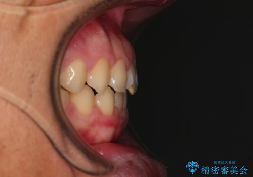舌突出癖で隙間の空いてしまう歯列　舌トレーニングを行ったインビザライン矯正の治療後