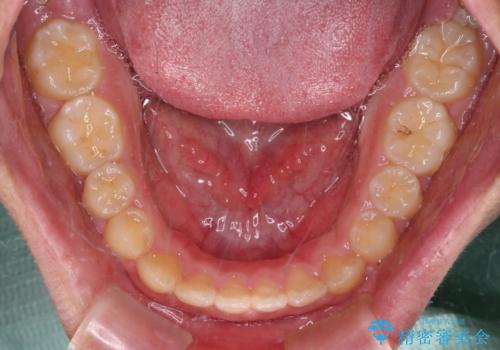 舌突出癖で隙間の空いてしまう歯列　舌トレーニングを行ったインビザライン矯正の治療後
