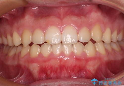 舌突出癖で隙間の空いてしまう歯列　舌トレーニングを行ったインビザライン矯正の治療中