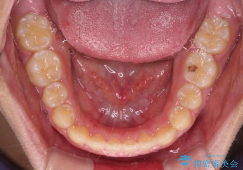 舌突出癖で隙間の空いてしまう歯列　舌トレーニングを行ったインビザライン矯正の治療中
