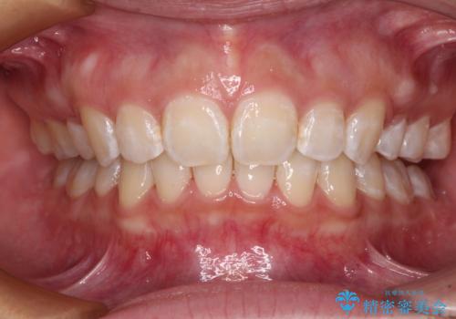上顎前突による口元の突出感　強く深い咬合をワイヤー矯正で改善していくの症例 治療後