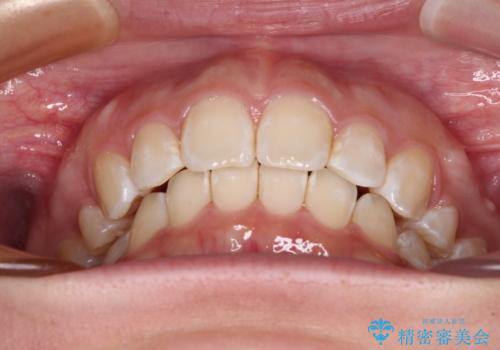 上顎前突による口元の突出感　強く深い咬合をワイヤー矯正で改善していくの治療後