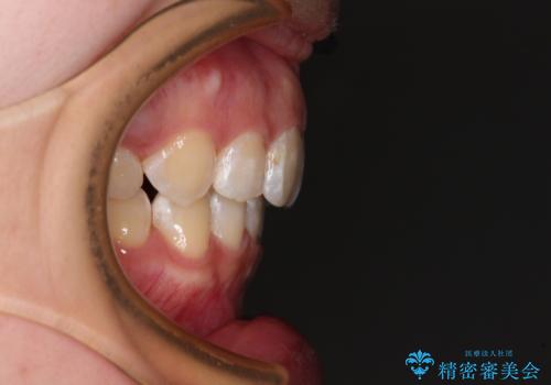 上顎前突による口元の突出感　強く深い咬合をワイヤー矯正で改善していくの治療後