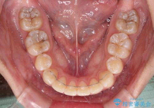 上顎前突による口元の突出感　強く深い咬合をワイヤー矯正で改善していくの治療後