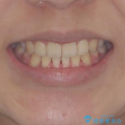 デコボコと八重歯の目立つ前歯　ワイヤー装置による抜歯矯正の治療後（顔貌）