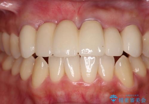 長く見える歯を治したい　歯肉移植による歯肉増大術の治療後