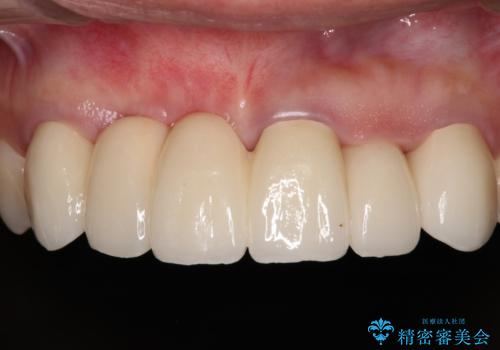 長く見える歯を治したい　歯肉移植による歯肉増大術の症例 治療後