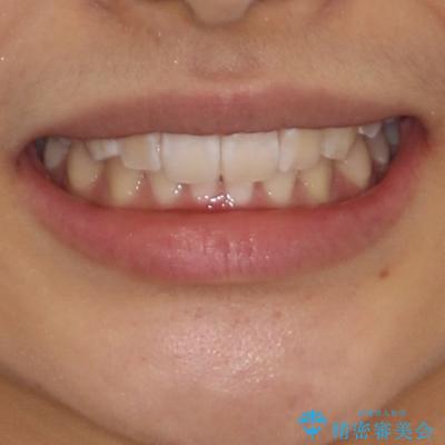 深い咬み合わせで前方に煽られた前歯 高校生のインビザライン矯正治療の治療後(顔貌)