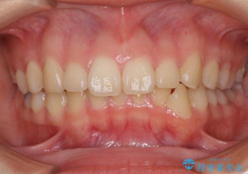 目立たない装置で出っ歯を治したい ハーフリンガル矯正の症例 治療前