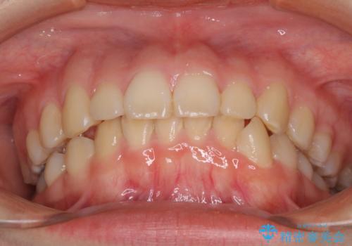 目立たない装置で出っ歯を治したい ハーフリンガル矯正の治療前