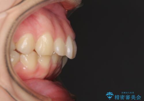 目立たない装置で出っ歯を治したい ハーフリンガル矯正の治療前