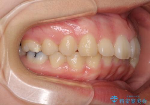 目立たない装置で出っ歯を治したい ハーフリンガル矯正の治療前
