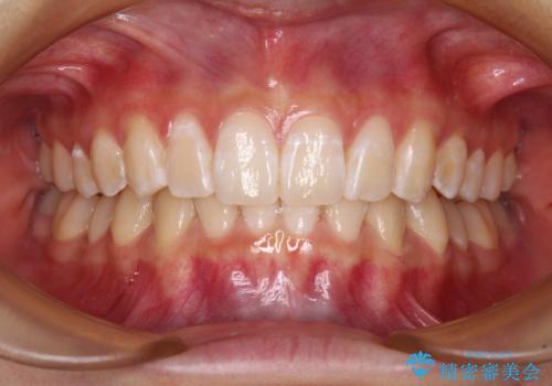 深い咬み合わせで前方に煽られた前歯 高校生のインビザライン矯正治療の症例 治療後