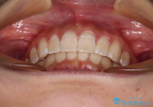 深い咬み合わせで前方に煽られた前歯 高校生のインビザライン矯正治療の治療後