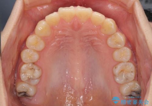 目立たない装置で出っ歯を治したい ハーフリンガル矯正の治療前