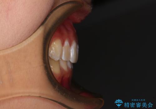 深い咬み合わせで前方に煽られた前歯 高校生のインビザライン矯正治療の治療後