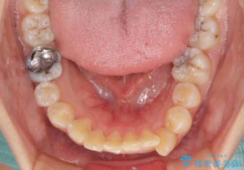目立たない装置で出っ歯を治したい ハーフリンガル矯正の治療前