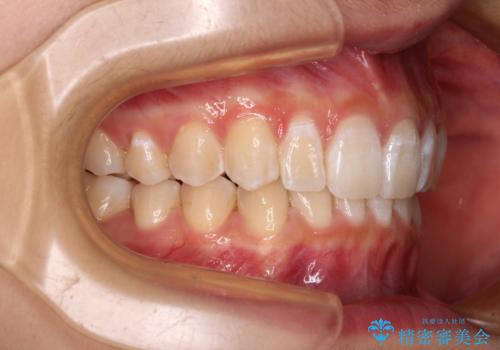 深い咬み合わせで前方に煽られた前歯 高校生のインビザライン矯正治療の治療後