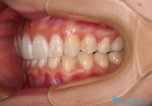 深い咬み合わせで前方に煽られた前歯 高校生のインビザライン矯正治療の治療後