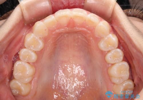 深い咬み合わせで前方に煽られた前歯 高校生のインビザライン矯正治療の治療後