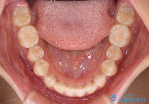 深い咬み合わせで前方に煽られた前歯 高校生のインビザライン矯正治療の治療後
