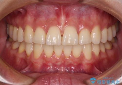 前にずれた咬み合わせをワイヤー装置でしっかりと改善の症例 治療後