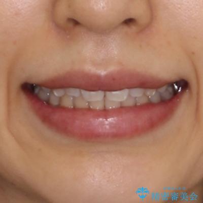 抜歯矯正の後戻り インビザライン・ライトによる矯正治療の治療後(顔貌)